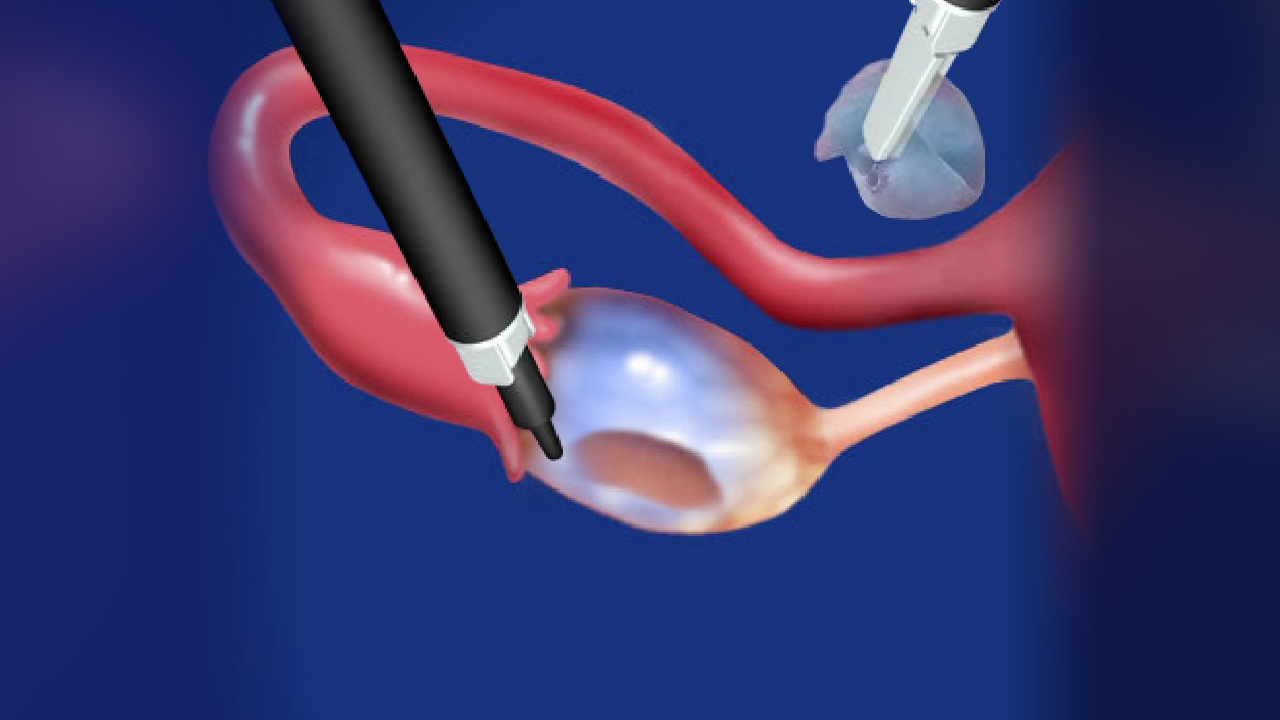 Ovarian cyst treatment in Jayanagar 4th Block